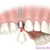 Где установить качественные зубные импланты?