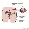 Внематочная беременность