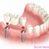 Протезирование зубов при отсутствии зубов